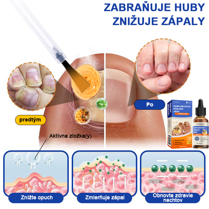 🐝🐝FurzeroTM Včelí jed na plesne na nechtoch: kompletné riešenie plesní na nechtoch 🌟👣