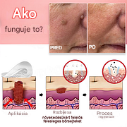 KUBOZN® Nano-mikroihličkové náplasti na odstraňovanie kožných bradavíc✨