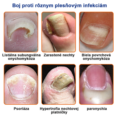 🐝🐝FurzeroTM Včelí jed na plesne na nechtoch: kompletné riešenie plesní na nechtoch 🌟👣