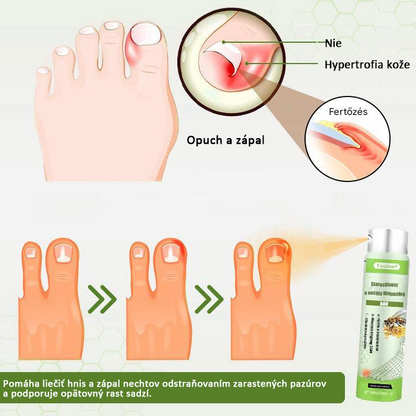 Časovo obmedzená zľava 50 % | Sprej s včelím jedom Foulme® NailRescue🐝